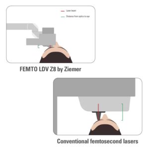 Top Benefits of Clear Neo LASIK Surgery-Super Low Energy for Faster Healing