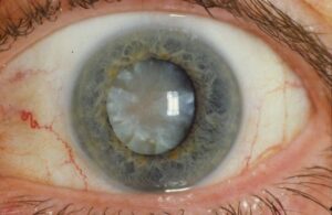 Eye Treatments Available at EyeMantra in Noida (Delhi NCR)-Cataract