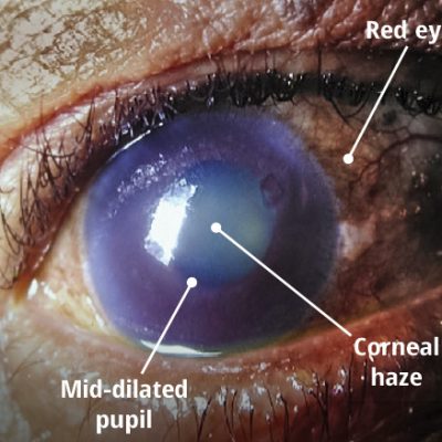 Glaucoma.