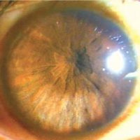 Pupillary abnormalities