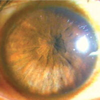 Pupillary abnormalities