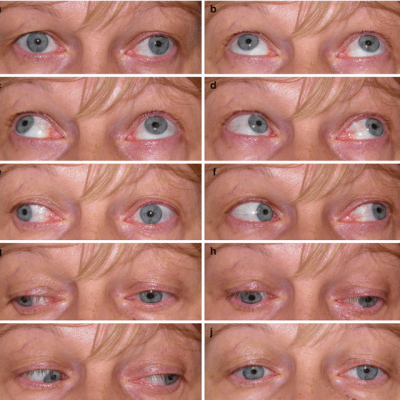 eye movement disorders